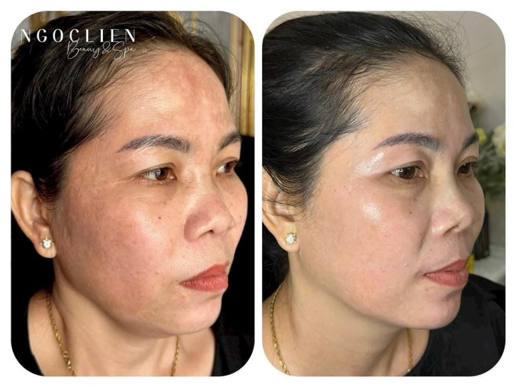 ịch sử điều trị nám của khách hàng 4 tại Spa ở TPHCM, thể hiện sự cải thiện theo thời gian
