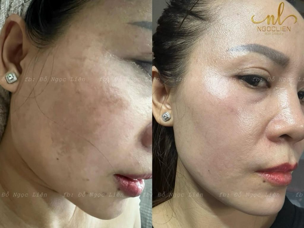 Hình ảnh thể hiện hiệu quả vượt trội trong điều trị nám tại Spa Ngọc Liên