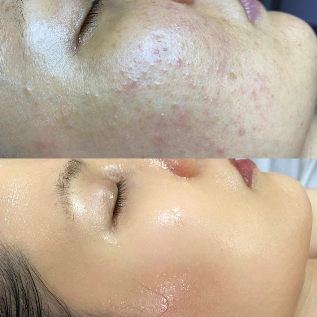 Hiệu quả trị mụn không để lại thâm của khách hàng tại Spa Ngọc Liên