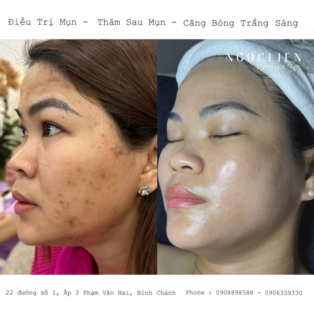 Điều Trị Nám Mụn Hiệu Quả Tại Spa Ngọc Liên - Bình Chánh - TPHCM