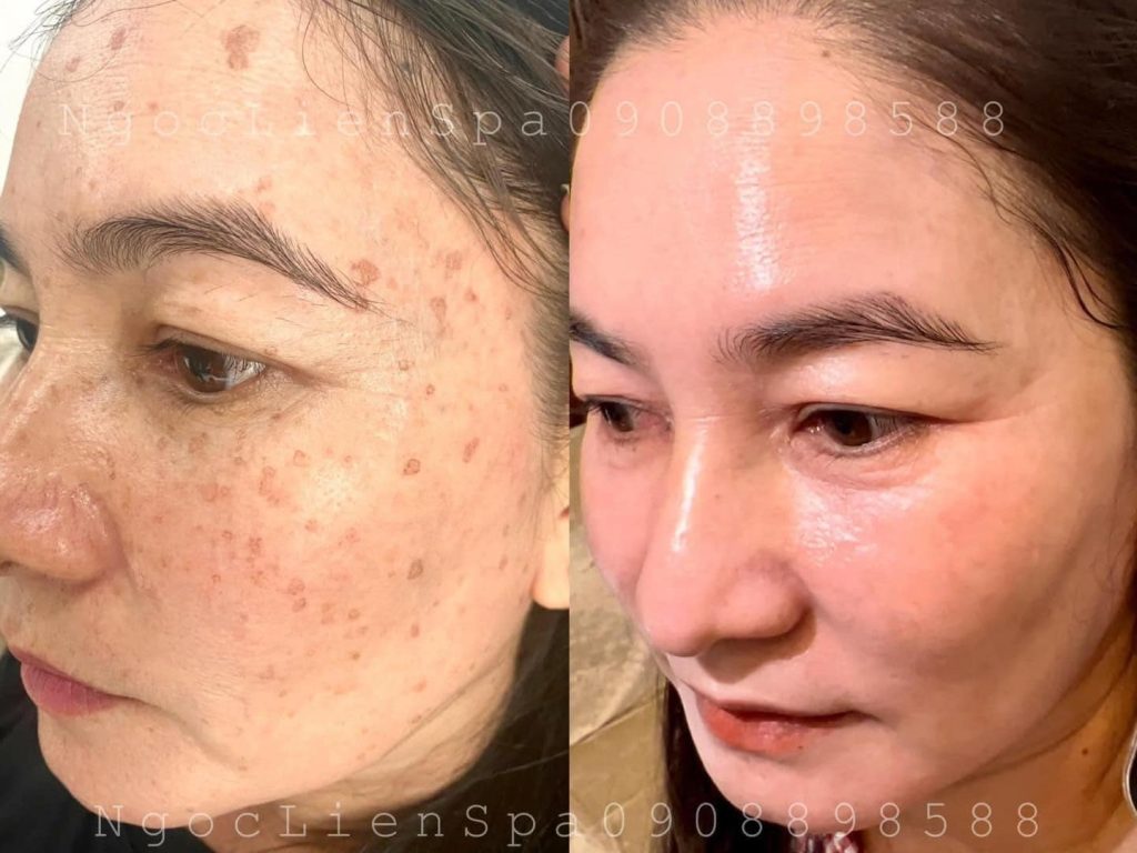 Hình ảnh trước và sau khi da hết nám và trở nên căng bóng tại Ngọc Liên