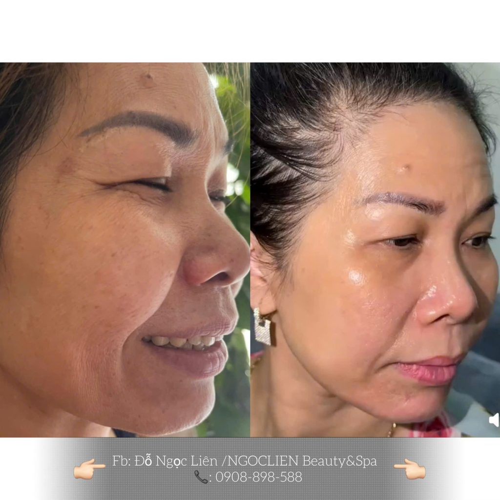 Liệu trình trị nám thành công tại NgocLien Beauty & Spa