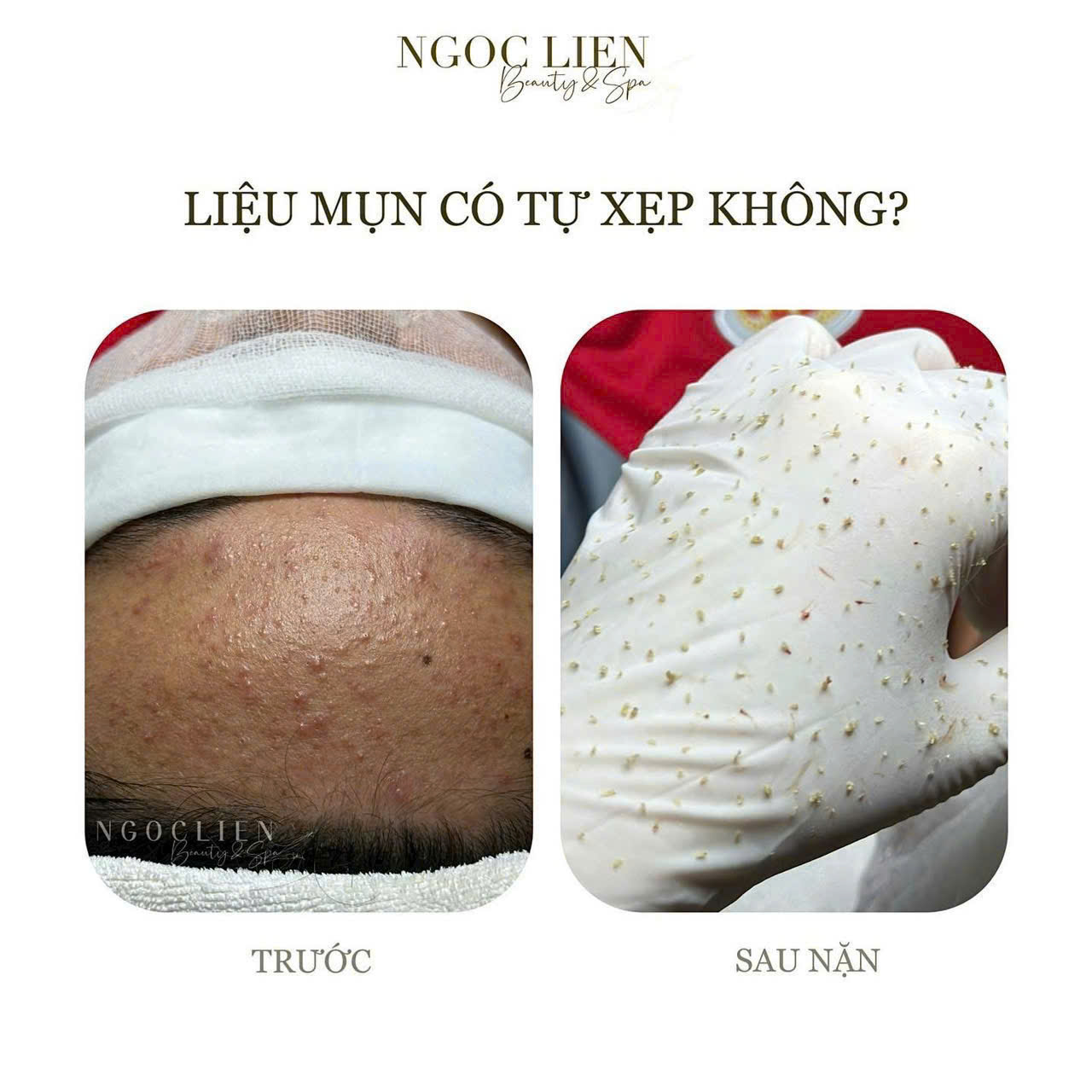 Hình ảnh thực tế quy trình lấy nhân mụn chuẩn y khoa tại Ngọc Liên Beauty & Spa Bình Chánh, TP Hồ Chí Minh