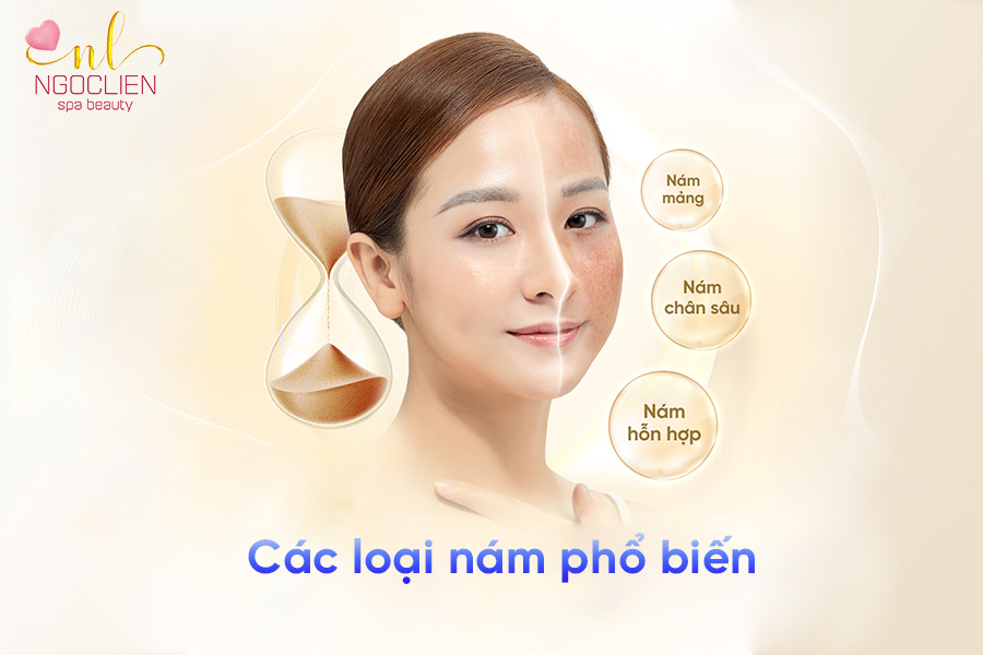 Trị nám tận gốc