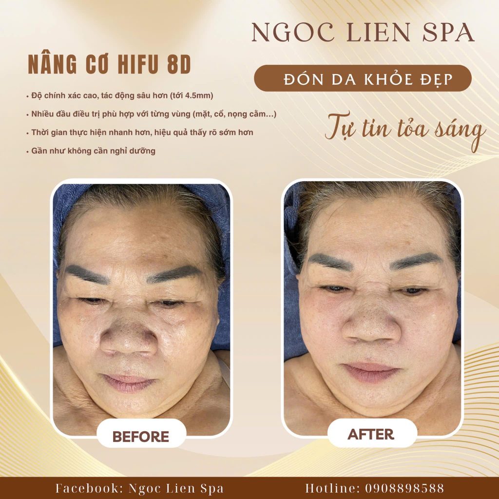 Giải pháp vàng điều trị tái tạo làn da chuyên sâu 6 Nang Co Tre Hoa 8D – Cong nghe HIFU 2025