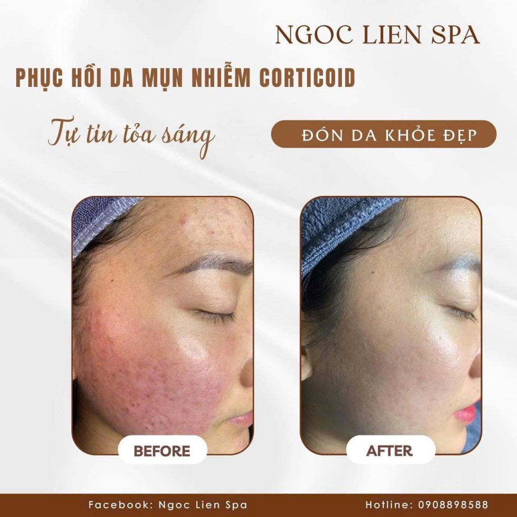 Giải pháp vàng điều trị tái tạo làn da chuyên sâu 5 corticoid