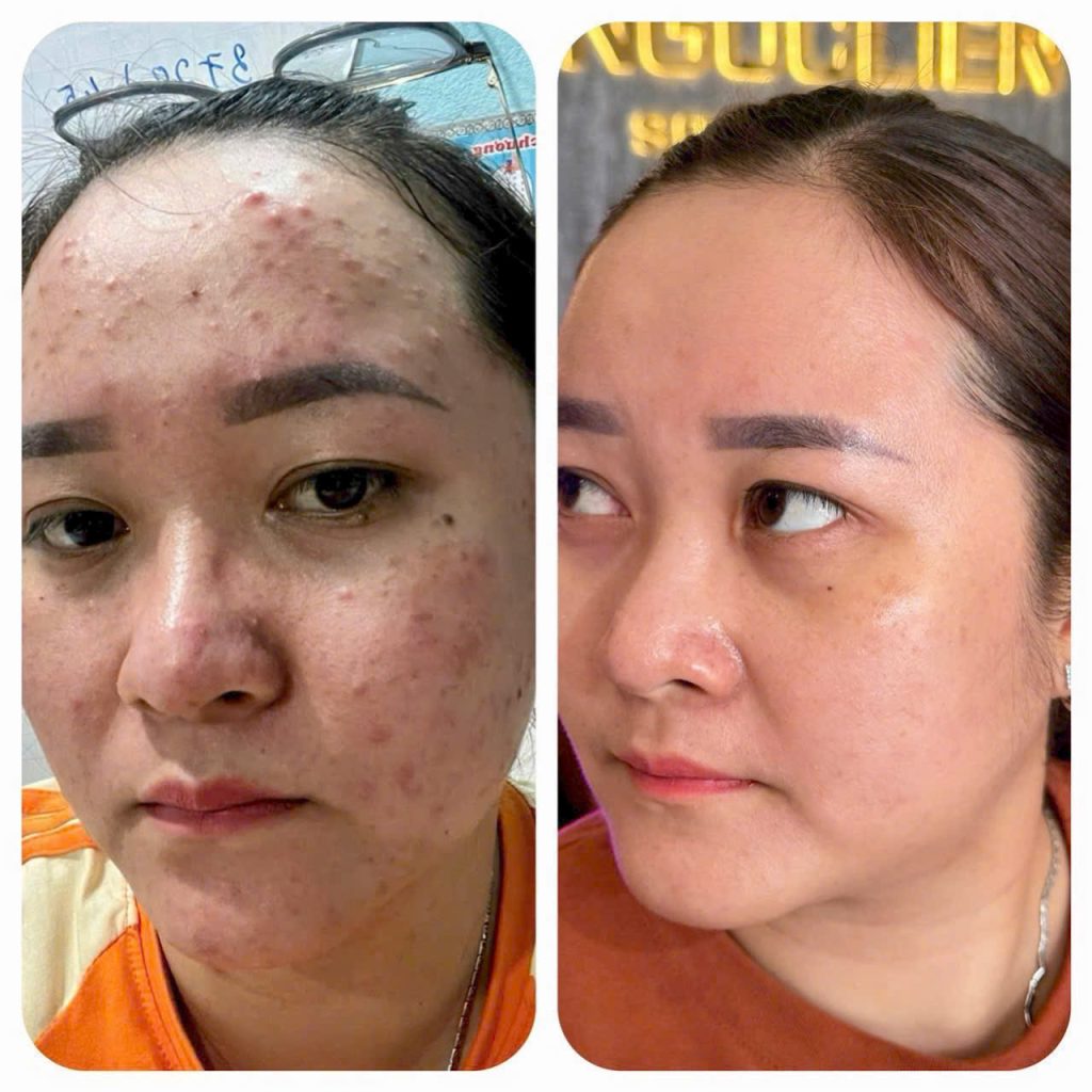 Điều trị nám, tàn nhang dứt điểm tại Spa Ngọc Liên 11 tri nam tan nhang 1