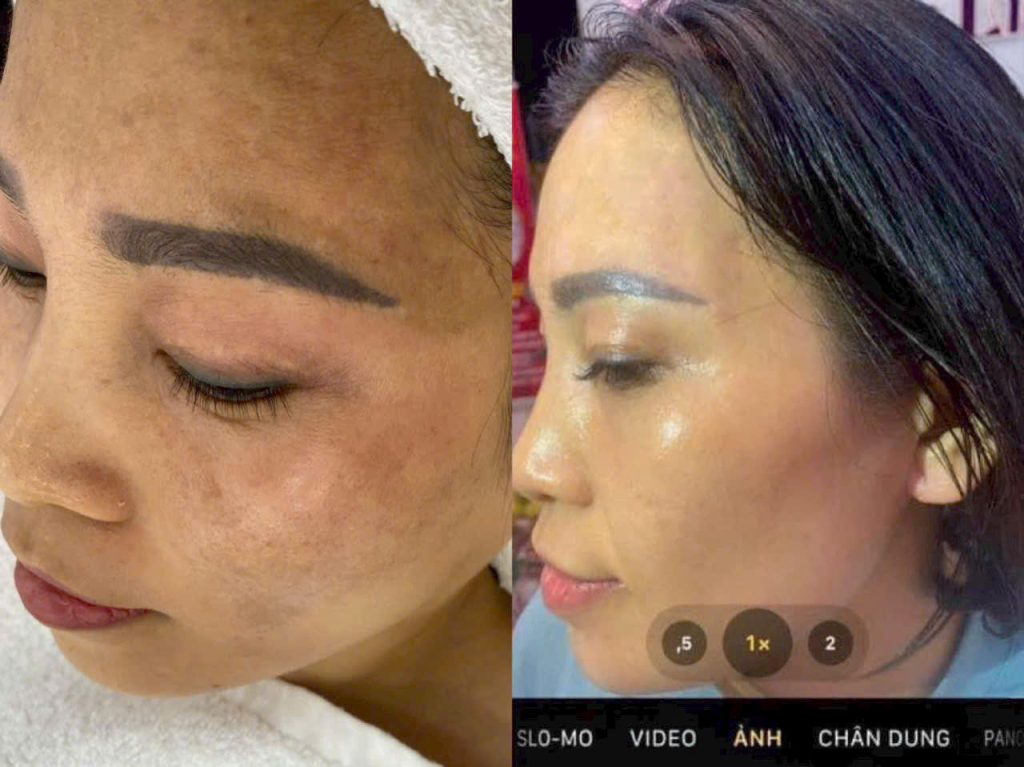 Điều trị nám, tàn nhang dứt điểm tại Spa Ngọc Liên 12 tri nam tan nhang