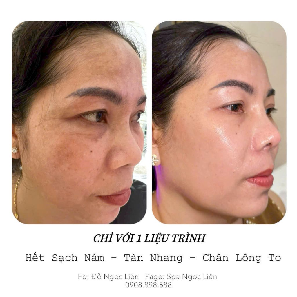 Điều trị nám, tàn nhang dứt điểm tại Spa Ngọc Liên 10 tri nam tan nhang 4