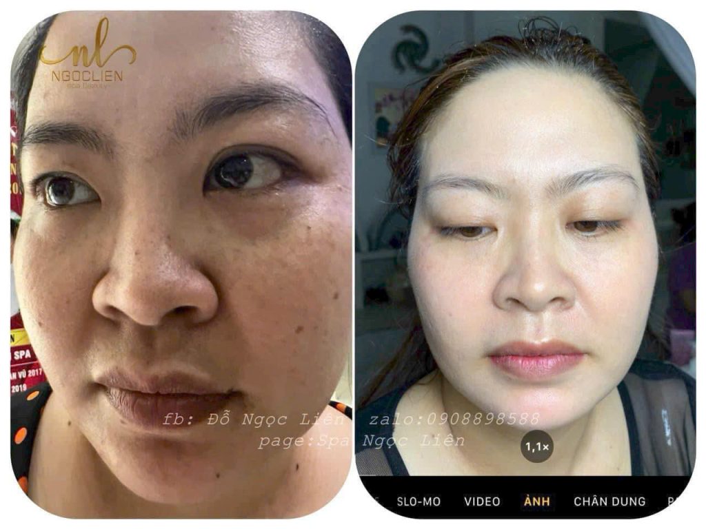 Điều trị nám, tàn nhang dứt điểm tại Spa Ngọc Liên 9 tri nam tan nhang 5