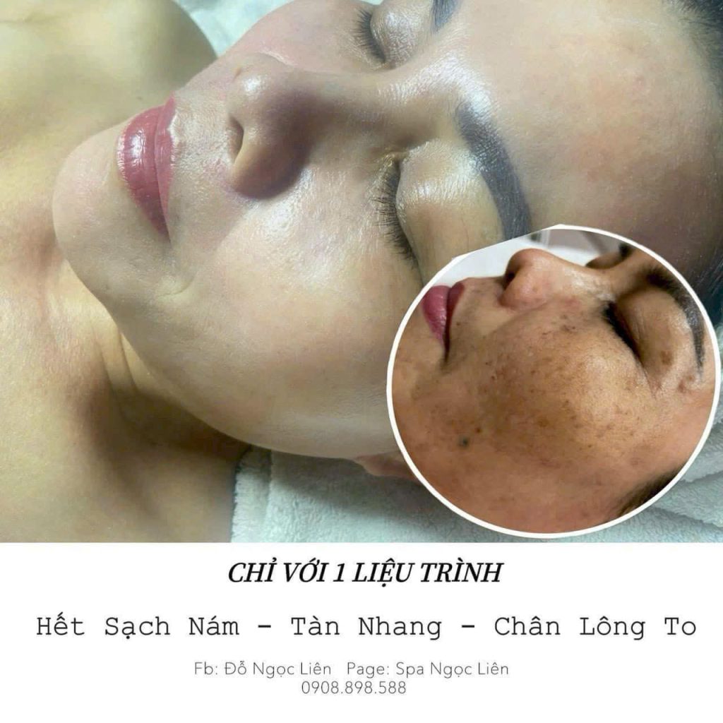 Điều trị nám, tàn nhang dứt điểm tại Spa Ngọc Liên 8 tri nam tan nhang 6